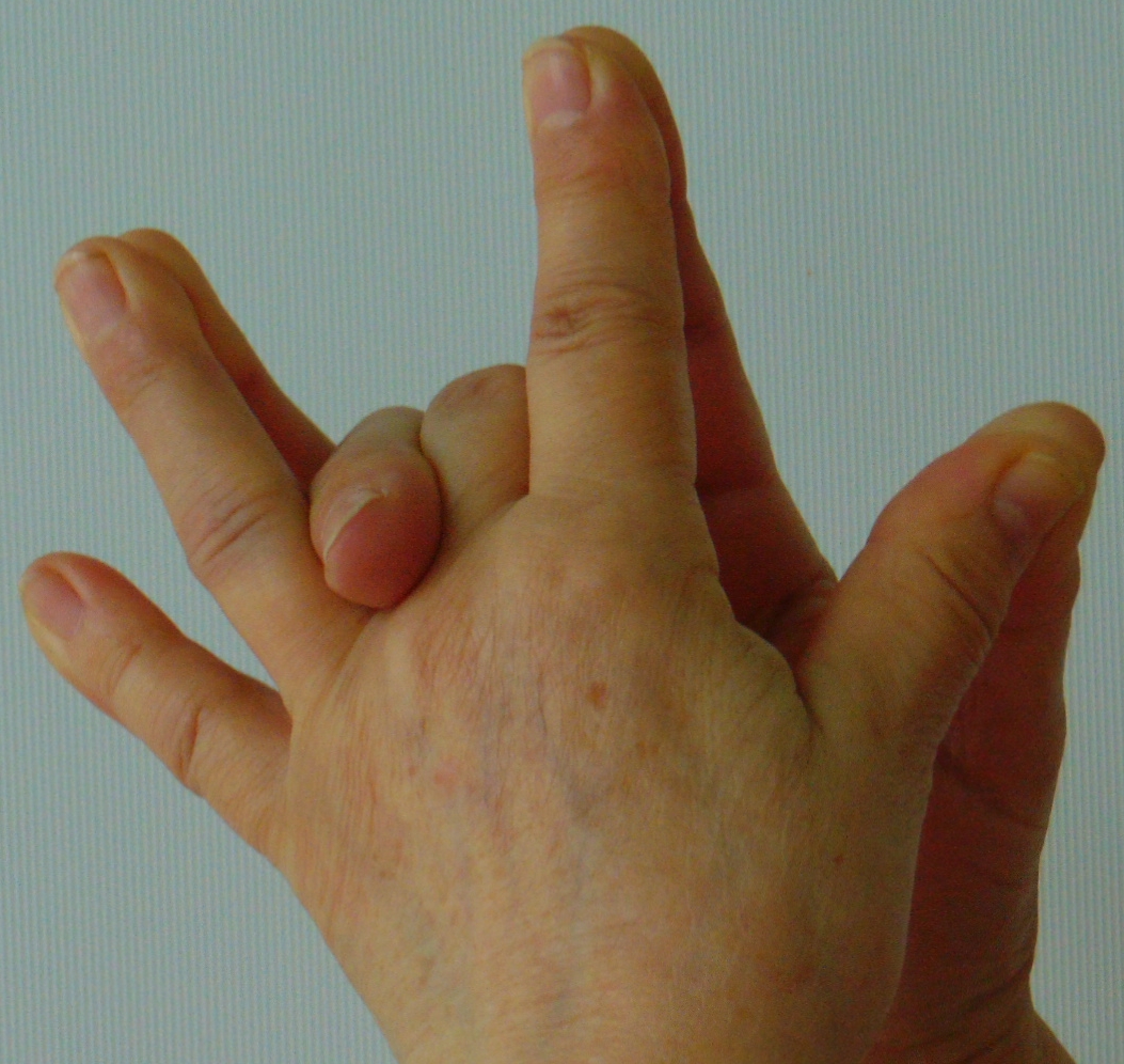 Mit csinálni fájó ízület a középső ujjon
